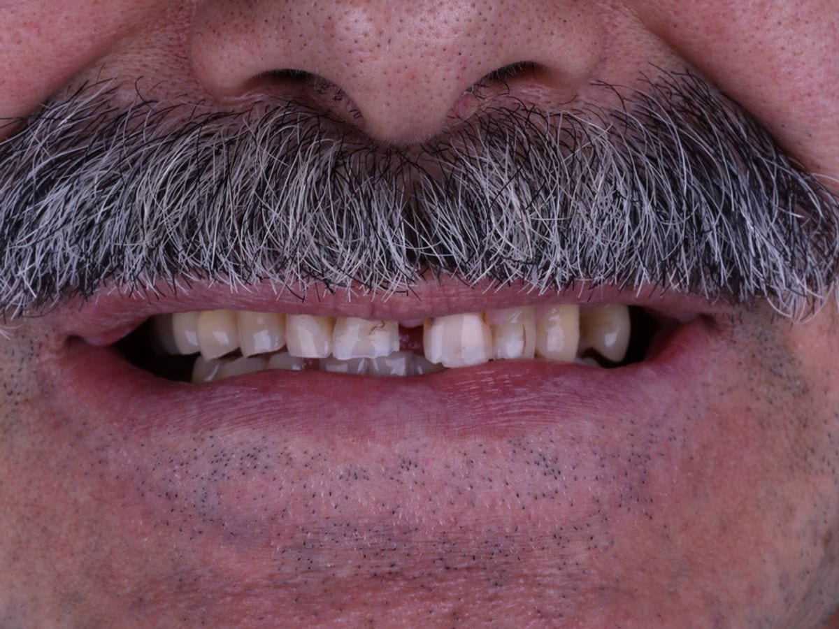Reabilitação estética do sorriso, antes