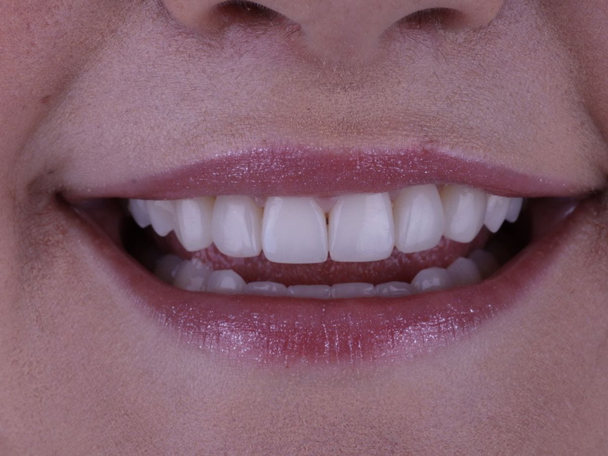 Lentes de contato dental, depois