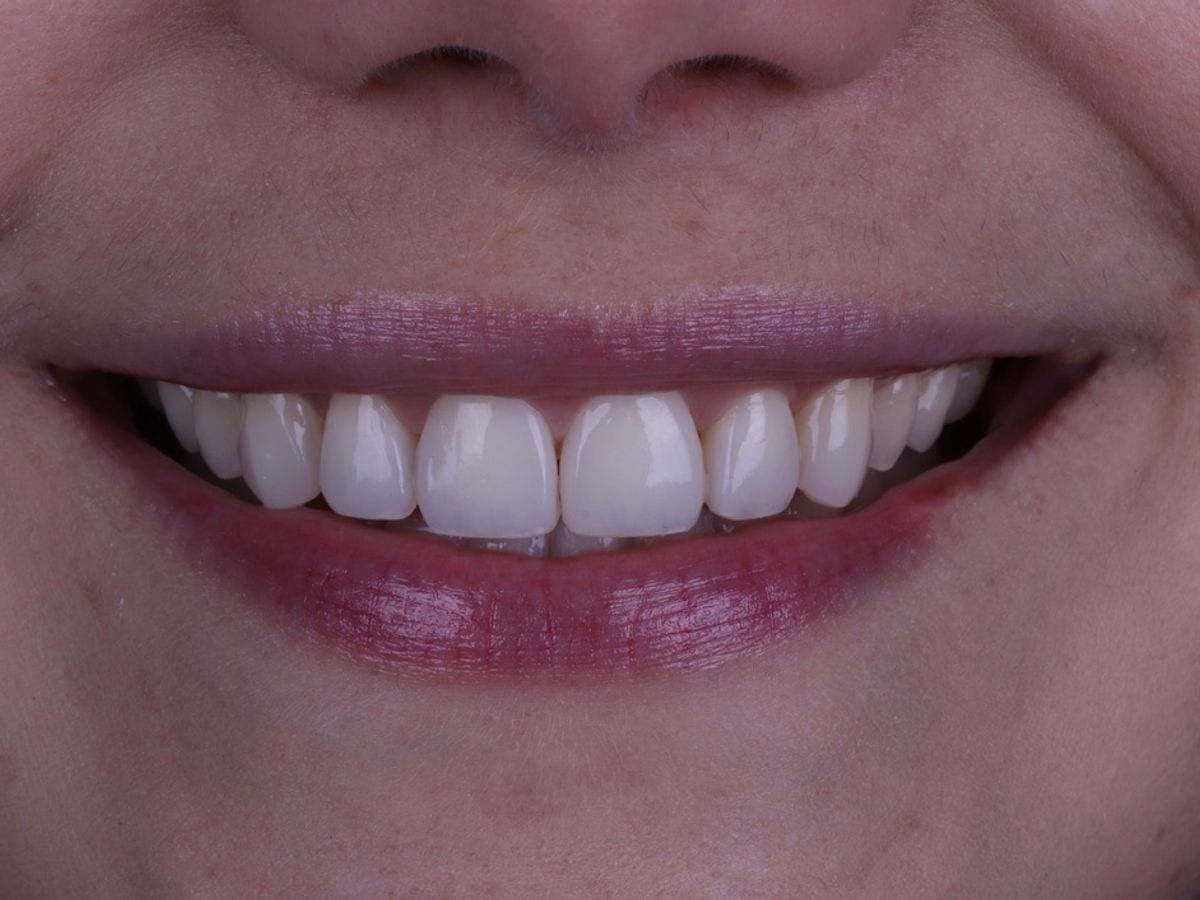 Fechamento de diastema, depois